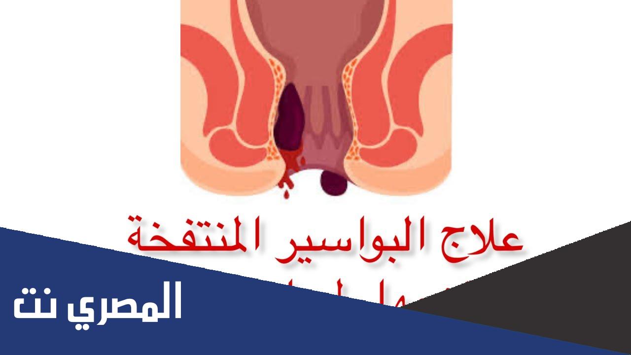 أمراض البواسير وعلاجها