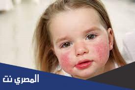 أنواع الحساسية وأعراضها