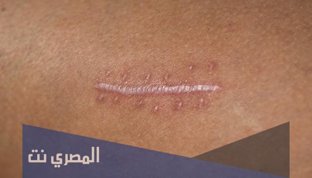 إزالة آثار العملية الجراحية طبيعيا