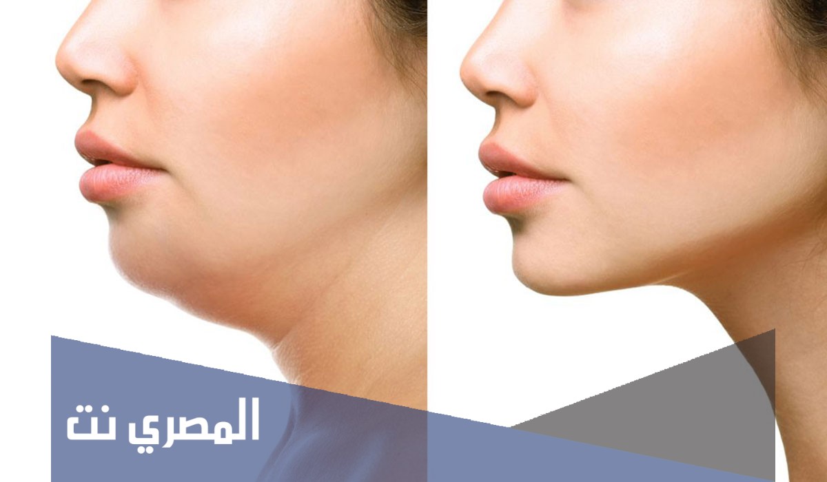إزالة الذقن المزدوج طبيعيا