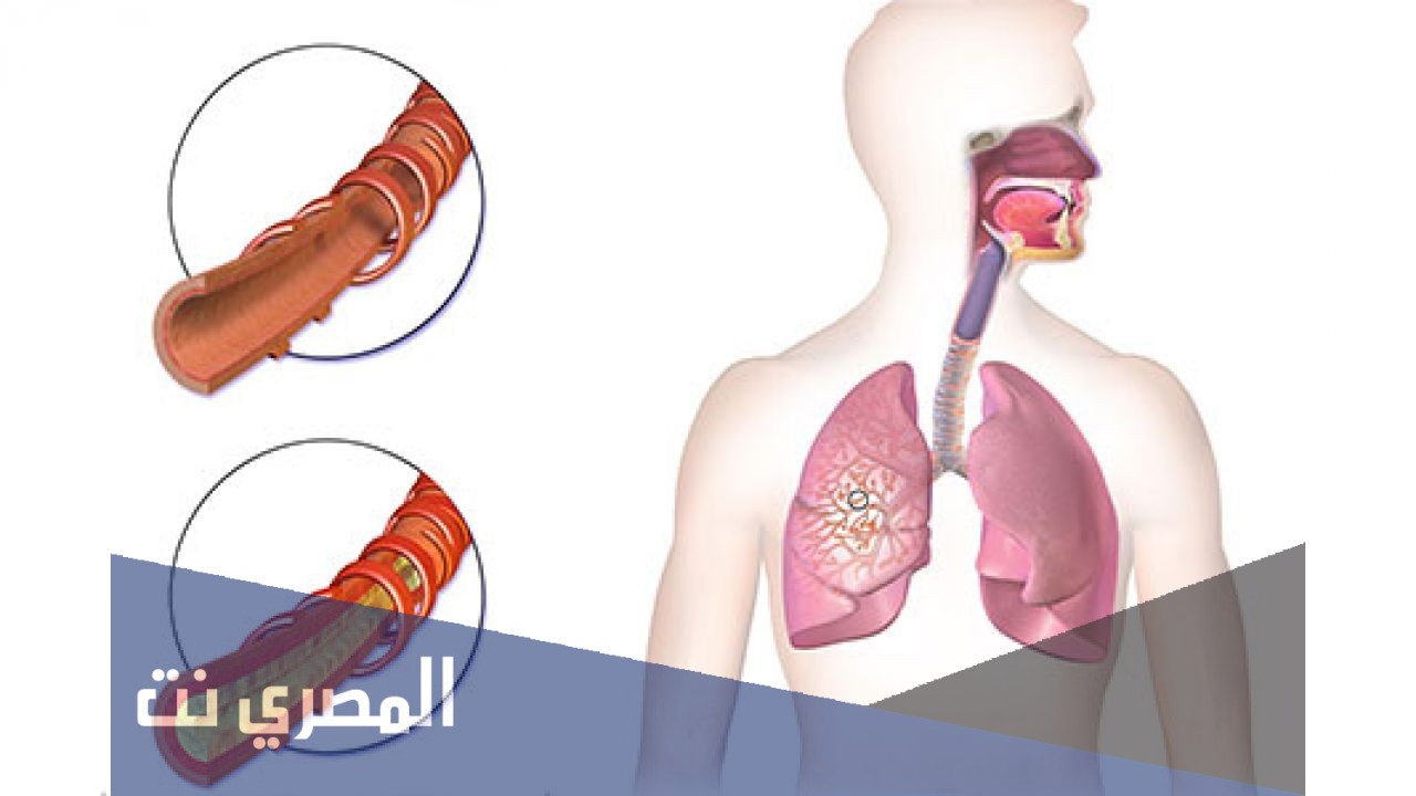 إلتهاب القصبات المزمن الانسدادي وعلاجه