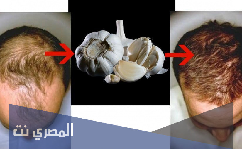 إنبات الشعر في الفراغات