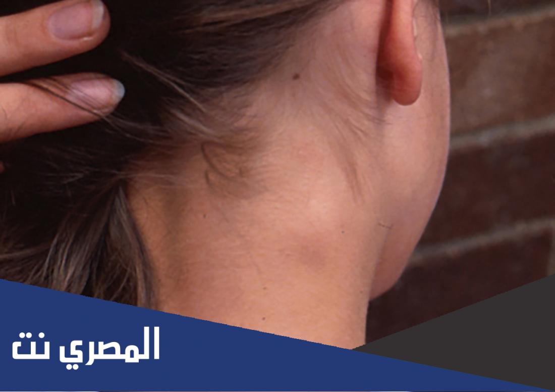 اسباب ظهور ورم في الرقبة من الجنب