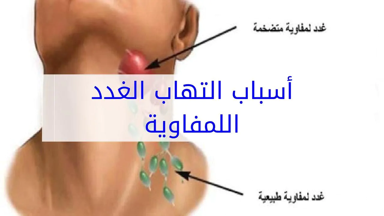 اعراض التهاب الغدد اللمفاوية تحت الفك وعلاجها