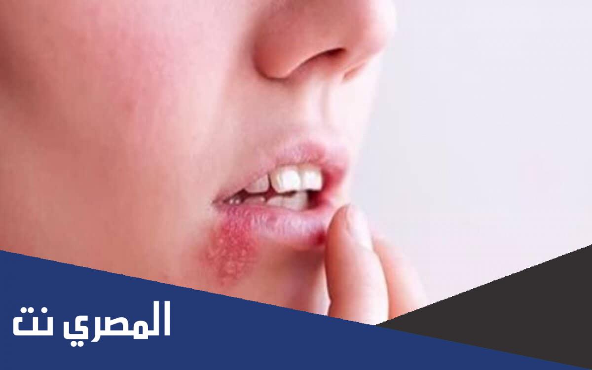 اعراض فيروس ebv وعلاجه