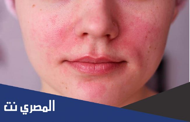 الاكزيما الدهنية في الوجه اسبابها وعلاجها