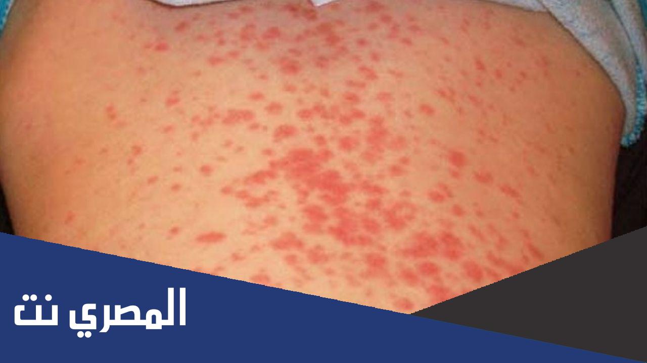 التأق ومرض الحساسية في الجسم