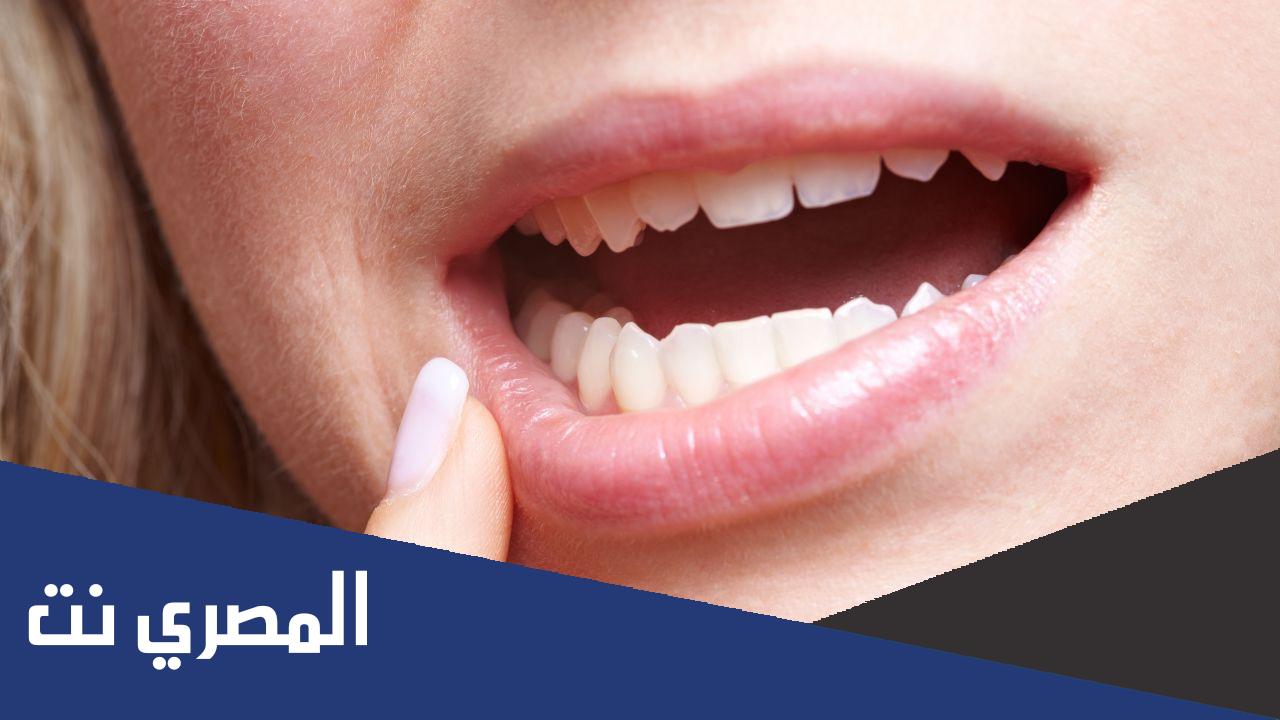 التهاب سقف الفم واللثة وعلاجه