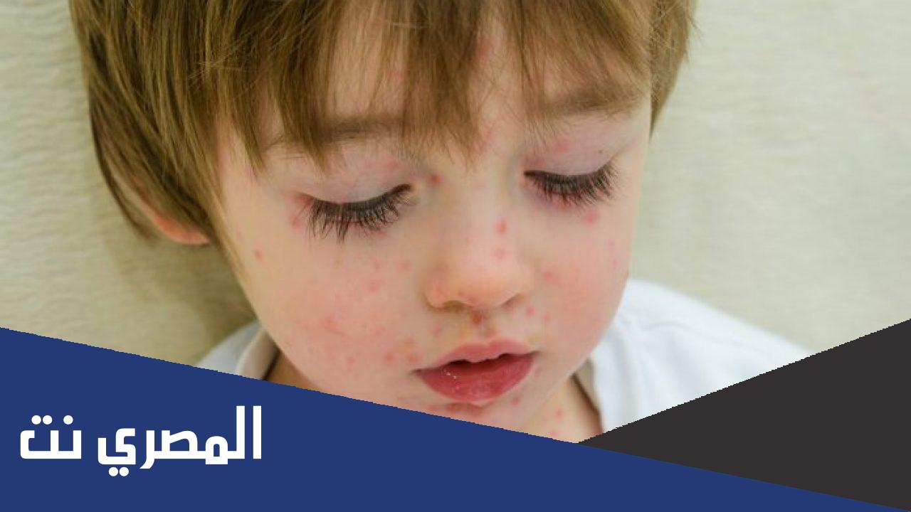 الجدري الكاذب وطرق الوقاية منه