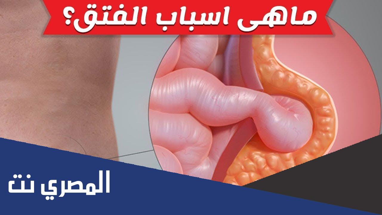 الفتق وأسبابه