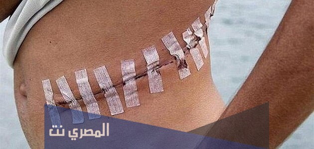 بحث قصير عن تجارة الاعضاء البشرية doc