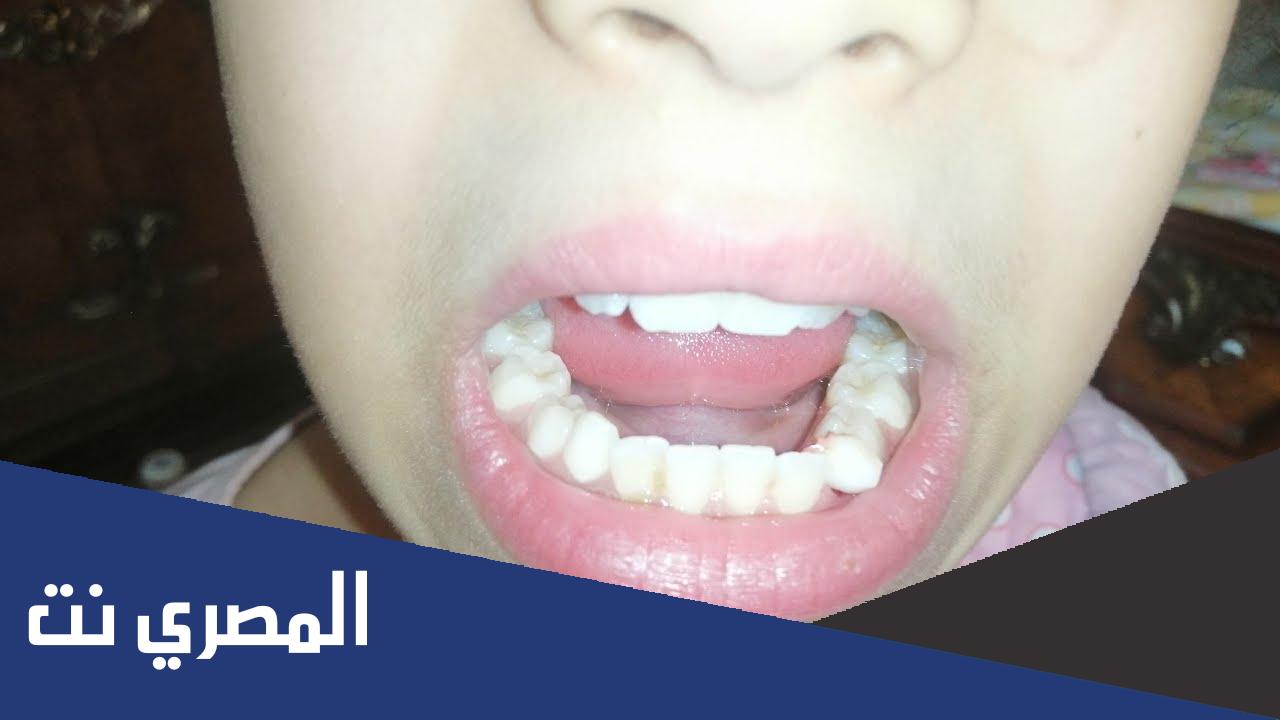 تبديل الأسنان والطواحين