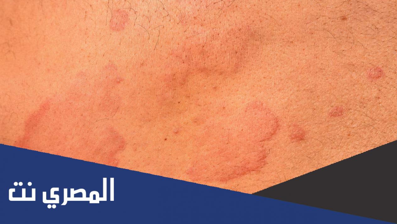 تحسس العفن أو الفطريات الجلدية