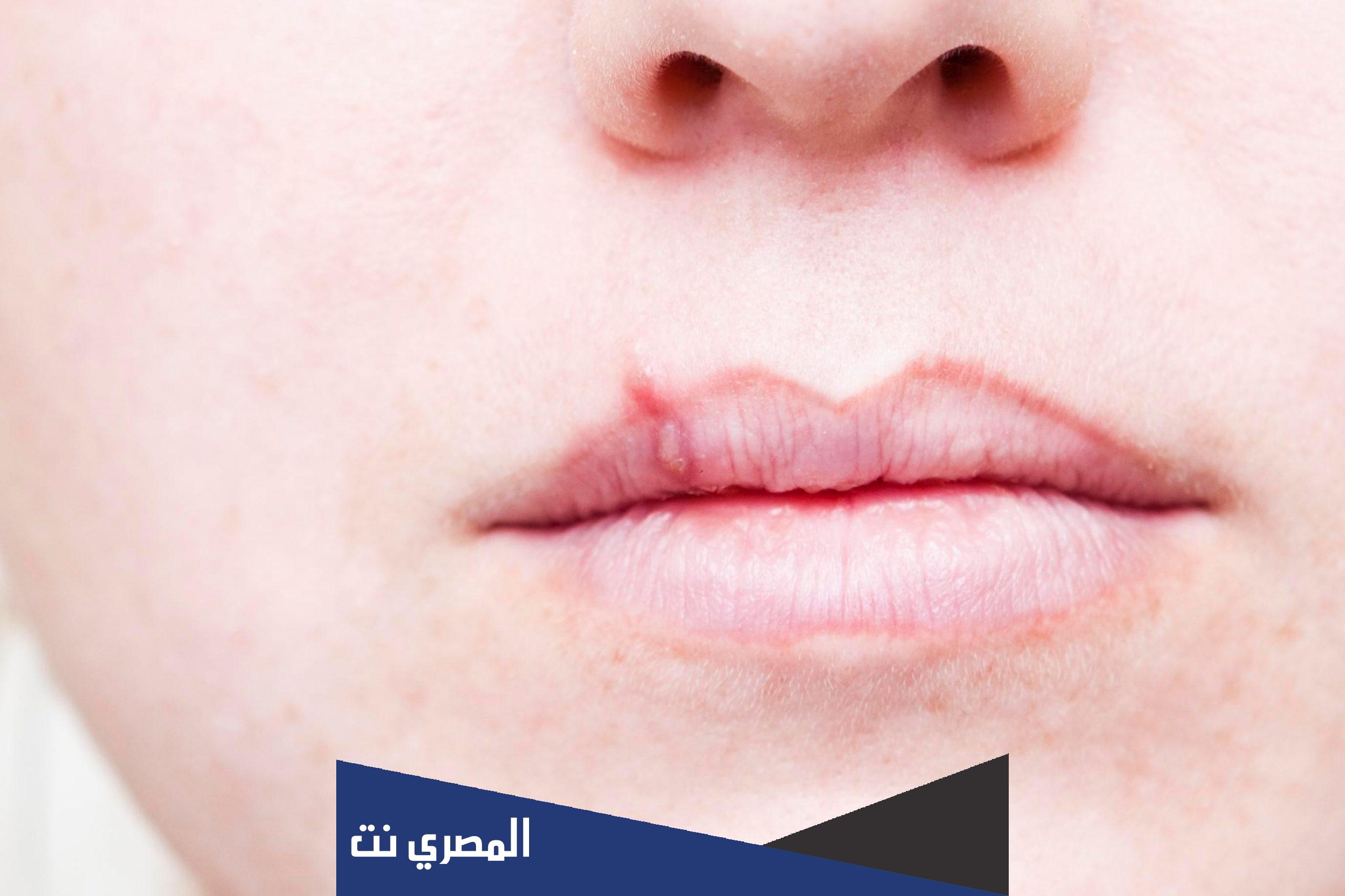 تحليل ebv للاطفال