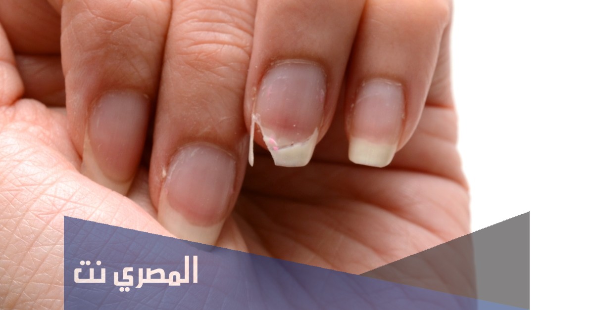 تكسر الأظافر أسبابه وطرق الوقاية منه