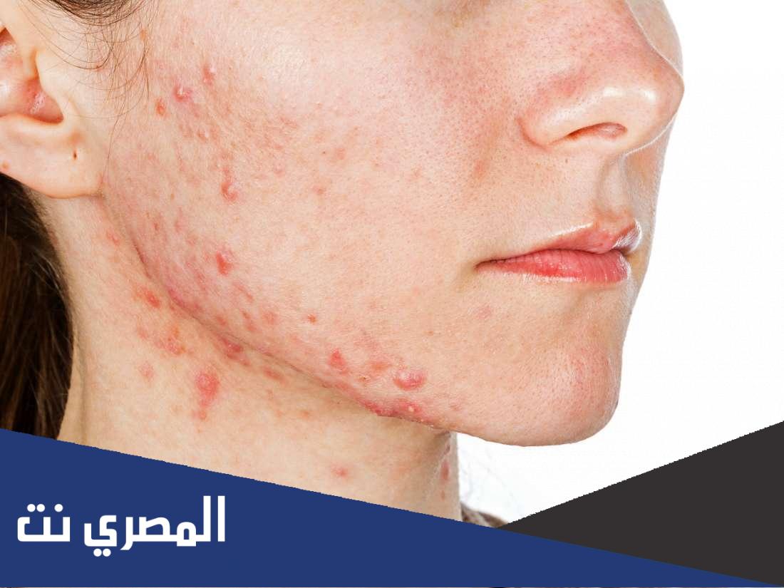 جيل ادانويد Adanoid لعلاج حب الشباب
