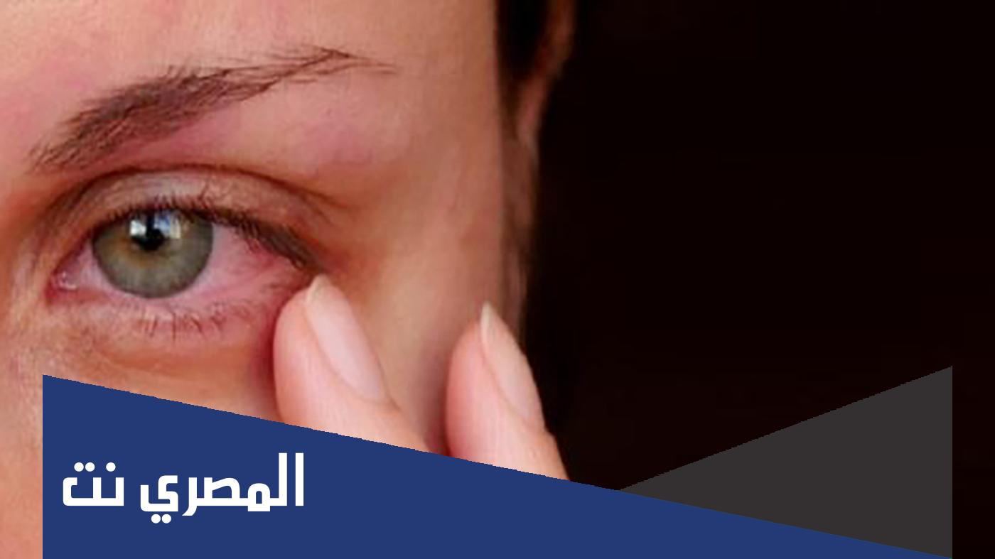 حرقان العين وعلاجها