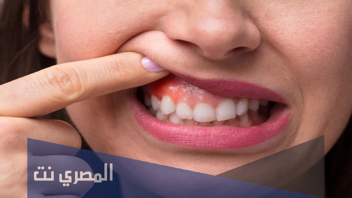 دواعي إستعمال Orovex مضمضة واهم التحذيرات!