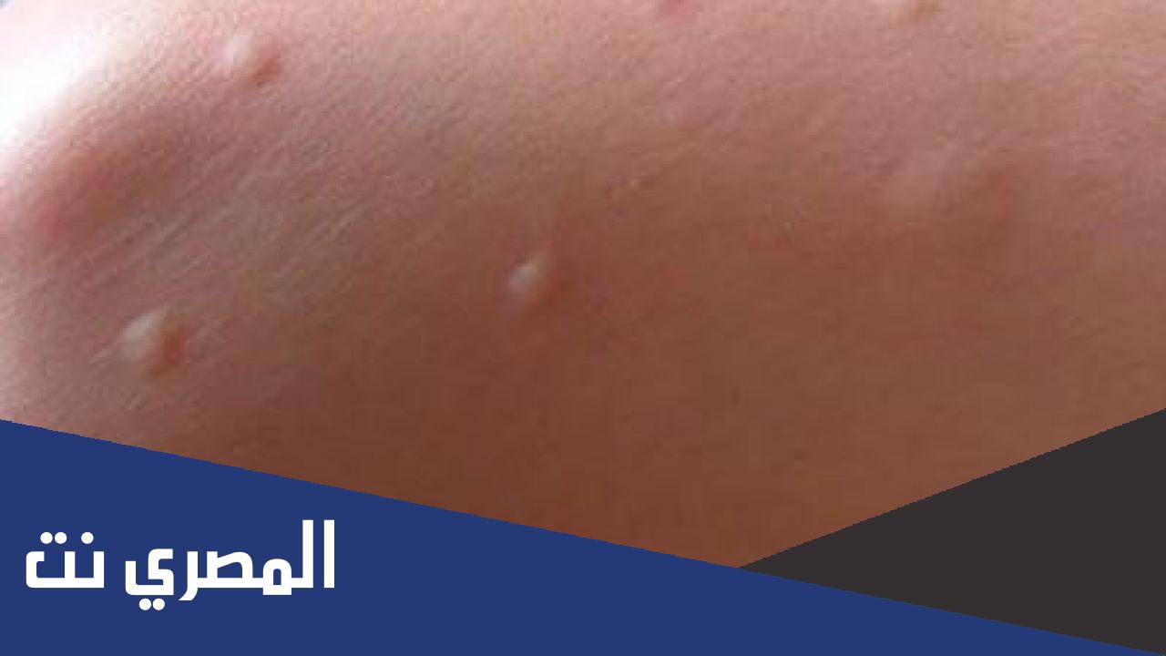 شكل قرصة البرغوث وعلاجها