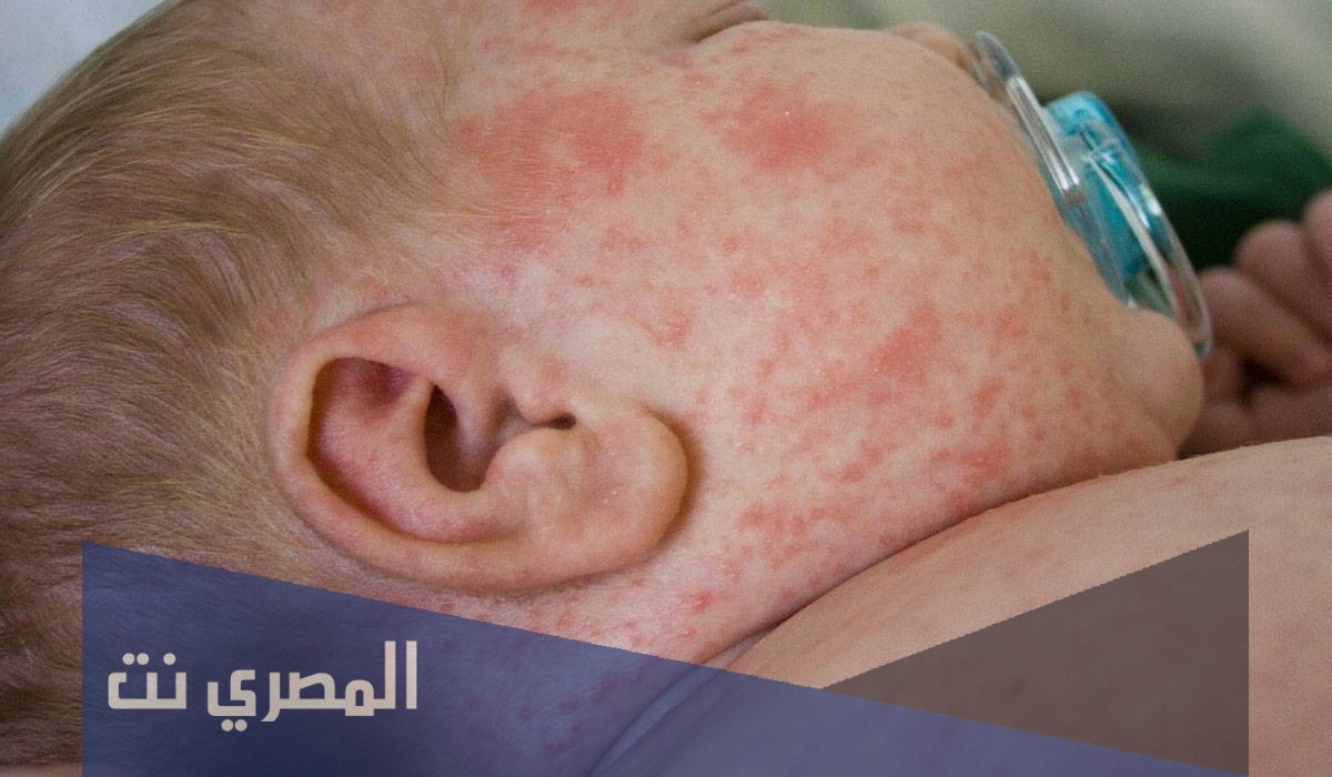 طرق علاج الحمونيل واعراضه