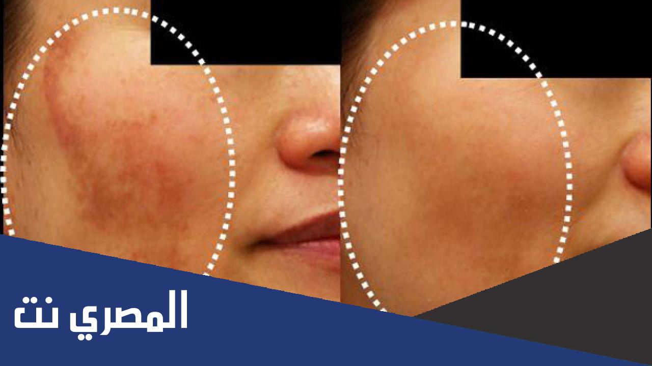 طريقة إزالة أثار الحروق من الوجه
