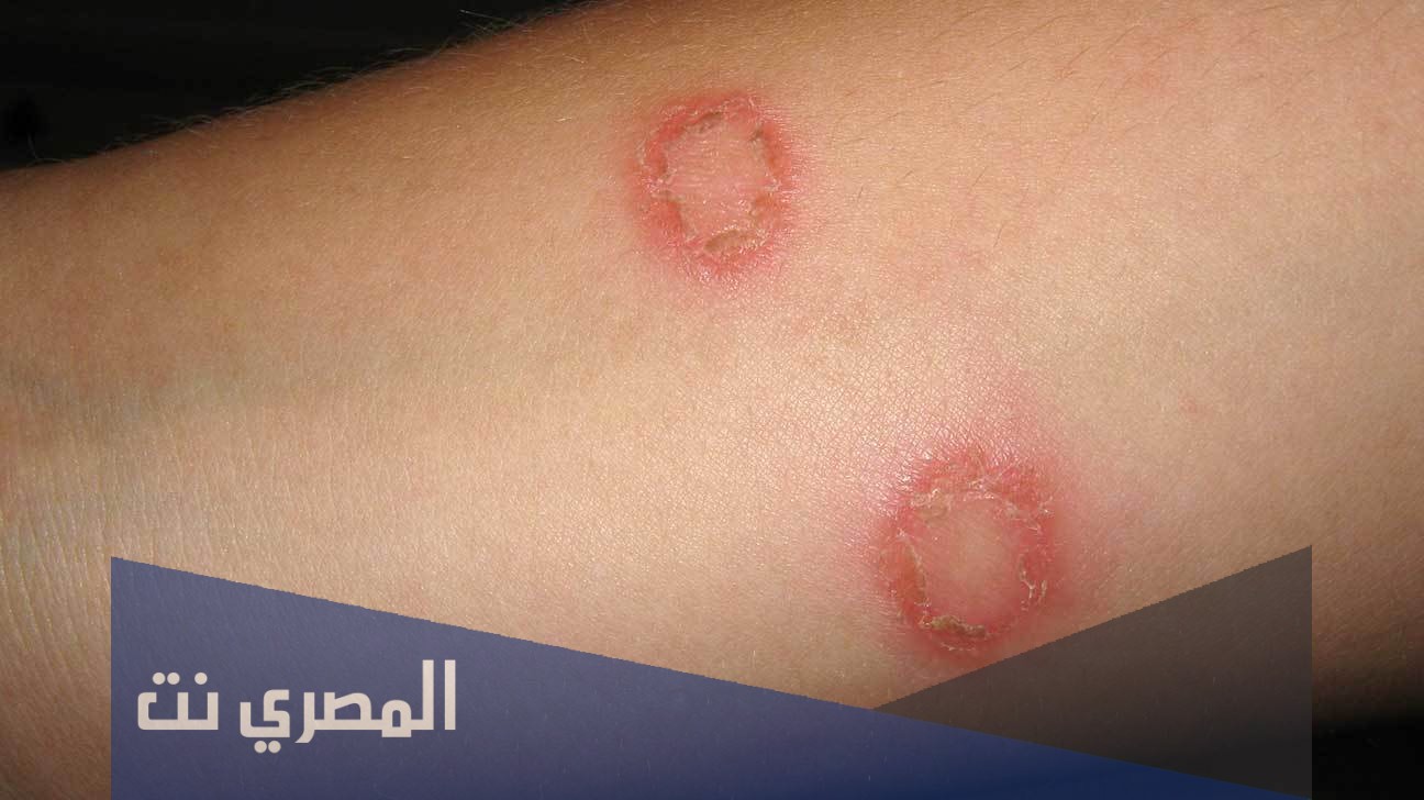 علاج الإكزيما المزمنة باستخدام مرهم ديبروساليك