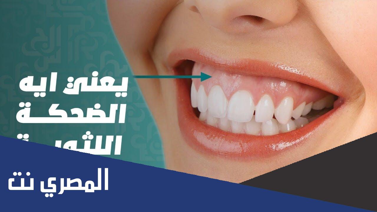 علاج الابتسامة اللثوية وبروز الفك العلوي