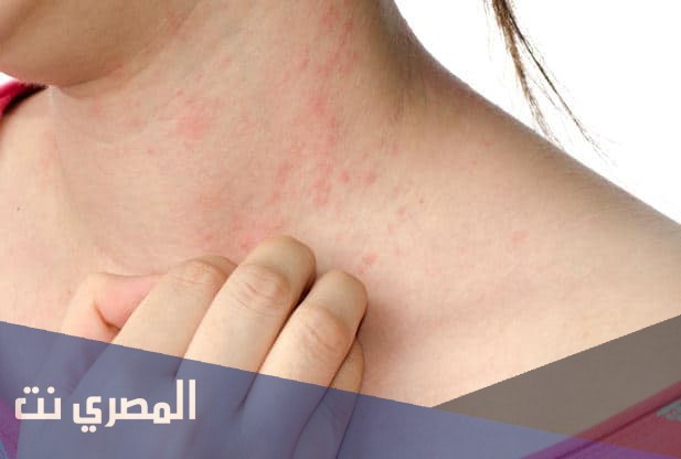 بريمو بلس primo Plus لعلاج التهيجات الجلدية وتأثيره