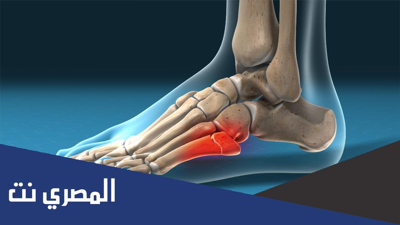 علاج الشوكة العظمية بالكعب بالثوم والأعشاب
