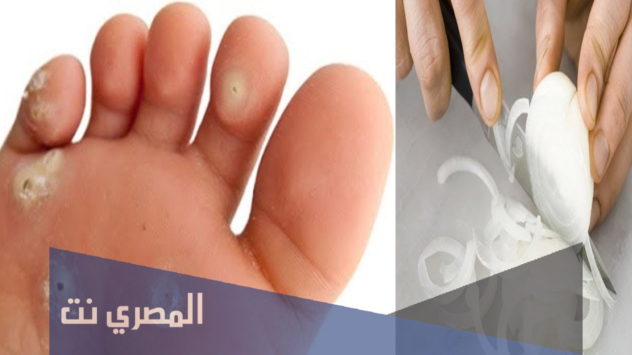 علاج الكالو واسبابه