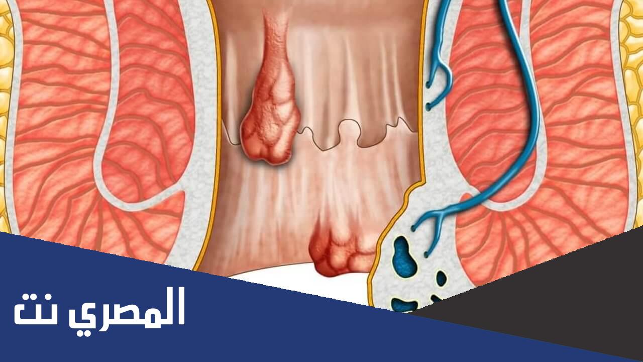 علاج انتفاخ في فتحة الشرج بدون الم
