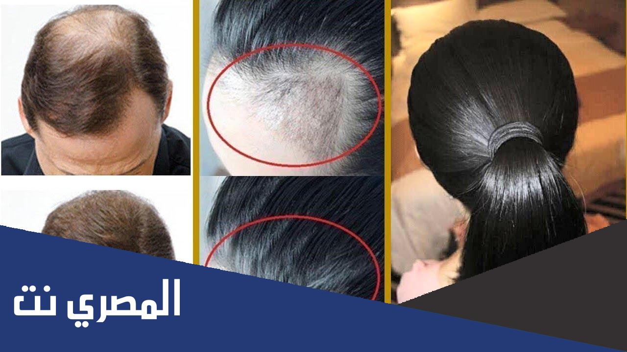 علاج تساقط الشعر عند الرجال من الامام