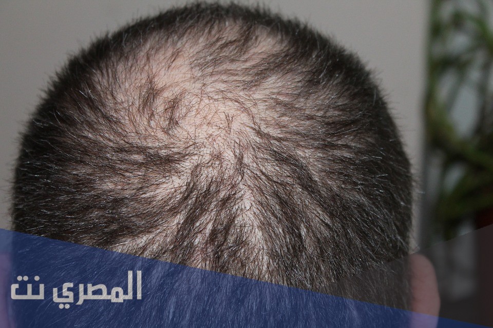 علاج تعرق فروة الرأس