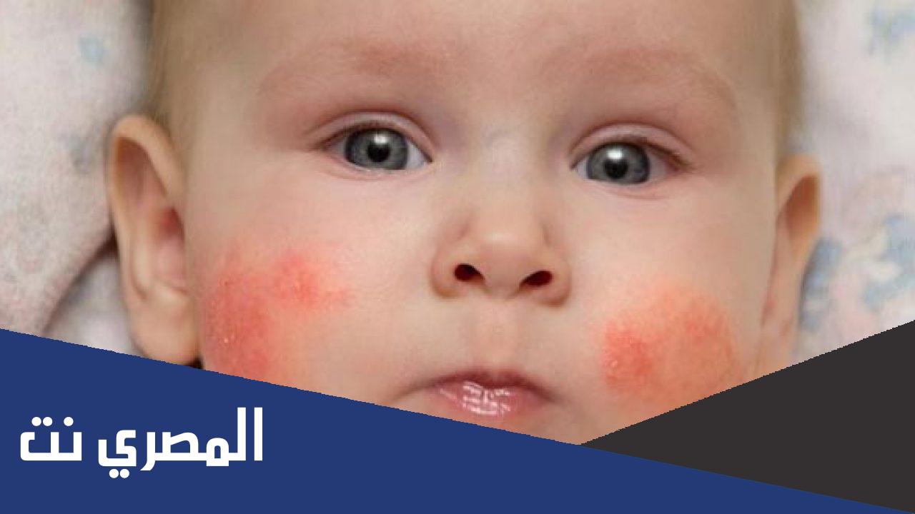علاج حساسية الخدود للأطفال