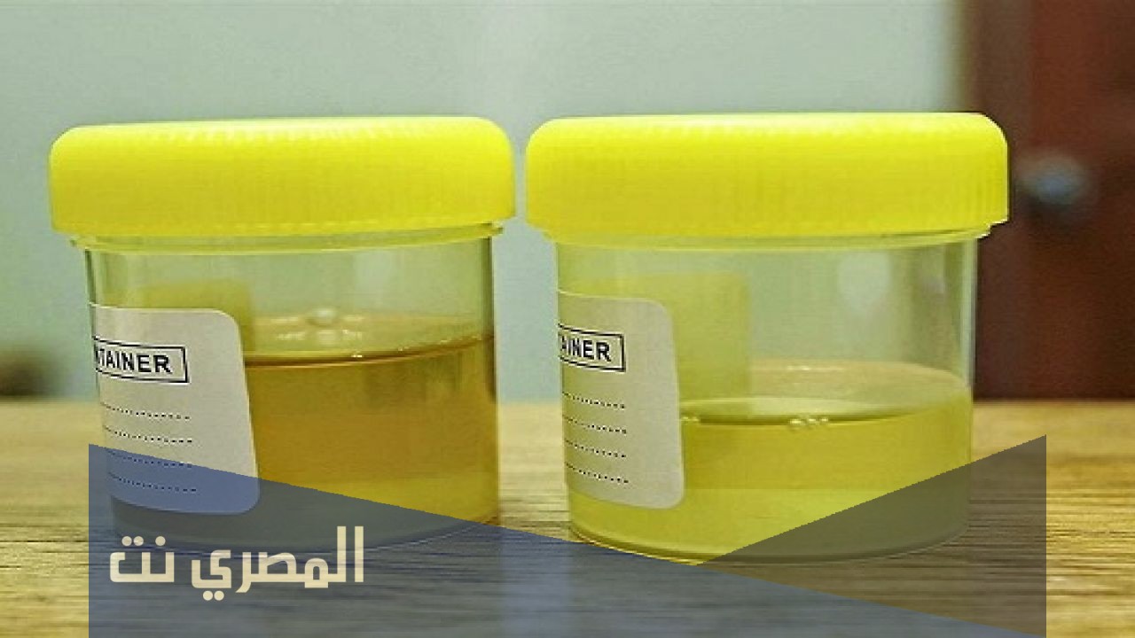 علاج زلال البول عند الأطفال