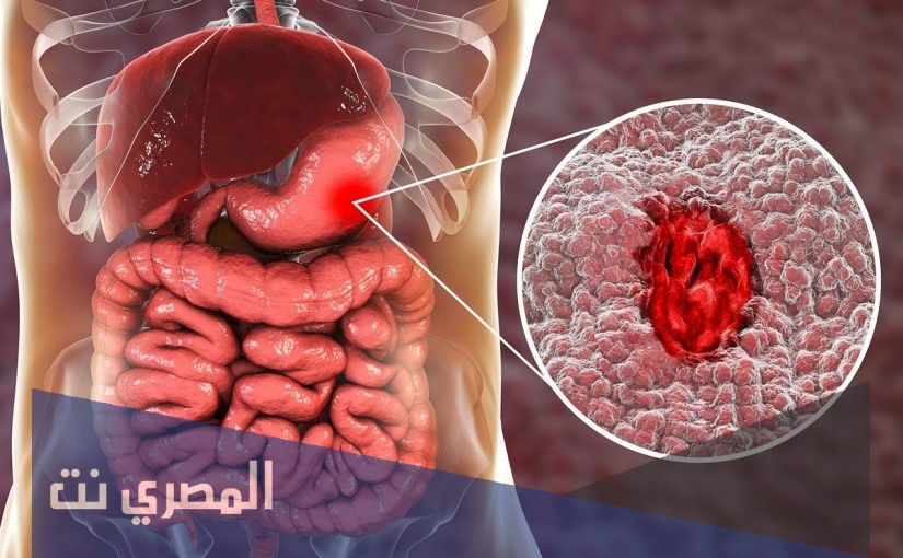 ميوكوستا Mucosta أقراص لعلاج قرحة المعدة وتأثيره