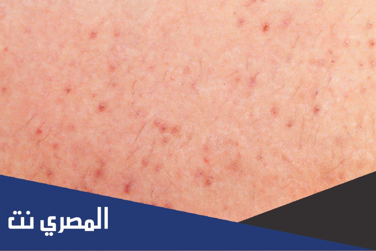 علاج مرض الجرب عند الإنسان