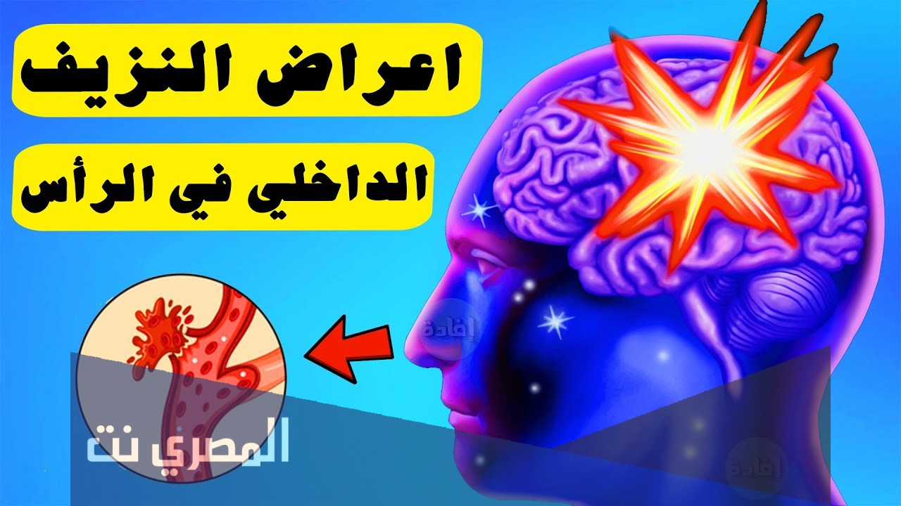 علامات النزيف الداخلي في الرأس