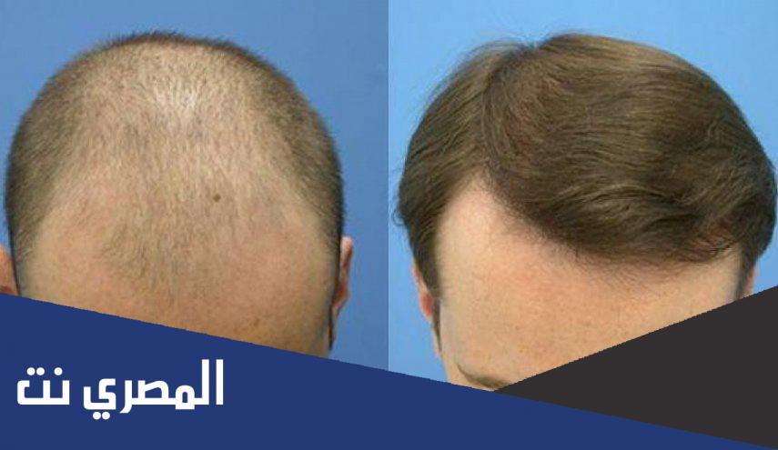 تكلفة زراعة الشعر في مصر بالتفصيل