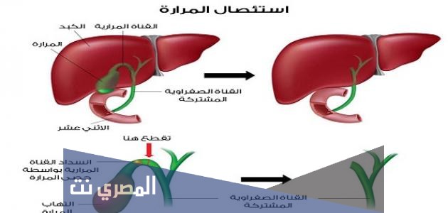 غذاء ما بعد عملية استئصال المرارة