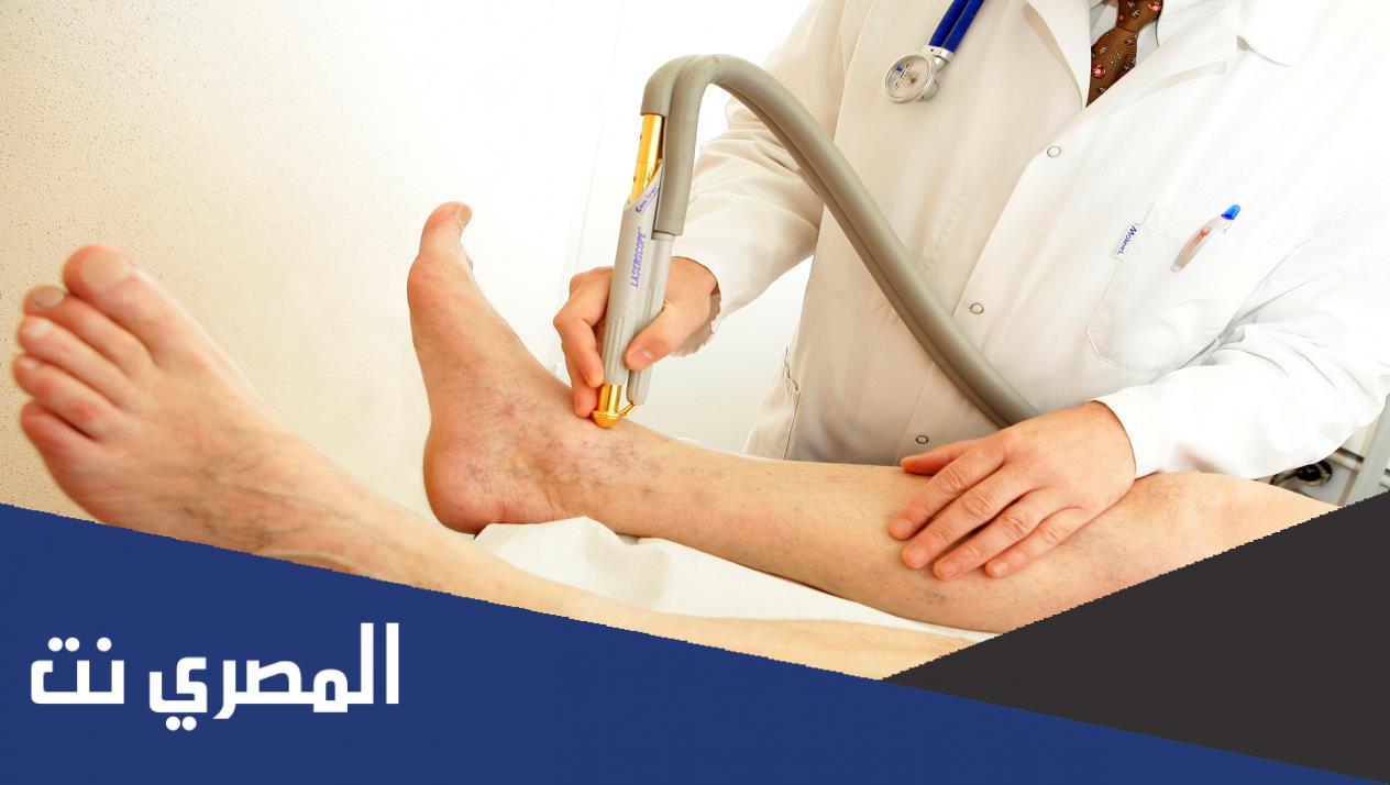 فوائد إجراء عمليه الدوالي