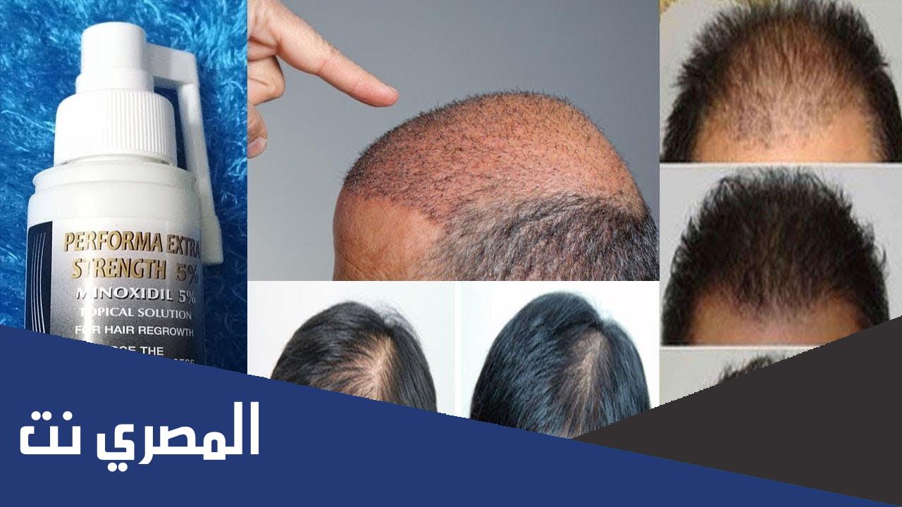 فوائد محلول المينوكسديل للبشرة والدقن