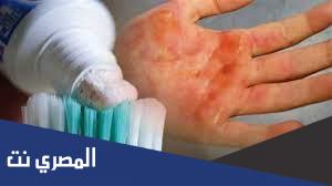 فوائد معجون الأسنان للحروق وأضراره