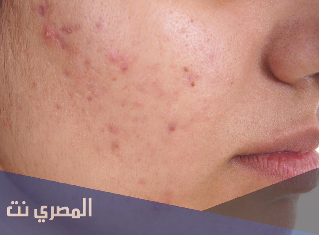 محلول أكني زنك Acne Zinc لعلاج حب الشباب وتأثيره
