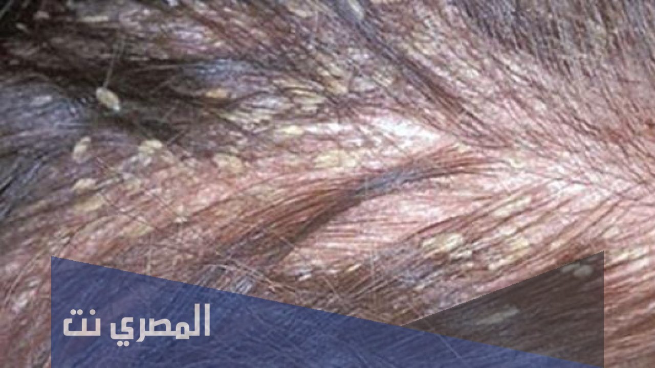 كيف أقضي على بيض القمل نهائيًا
