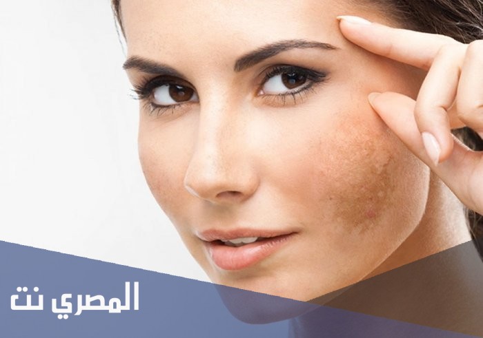 كيف تؤثر الشمس على البشرة؟