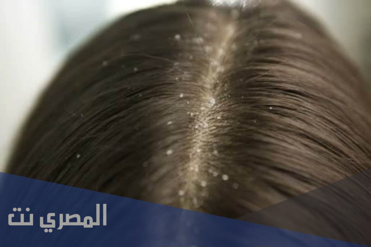 كيفية التخلص من القمل بالخل والملح