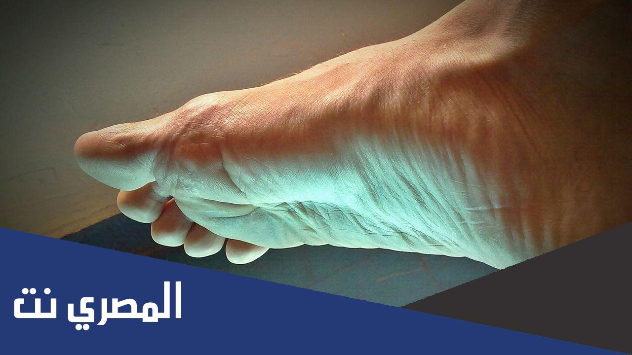 كيفية التخلص من مسمار القدم نهائيًا