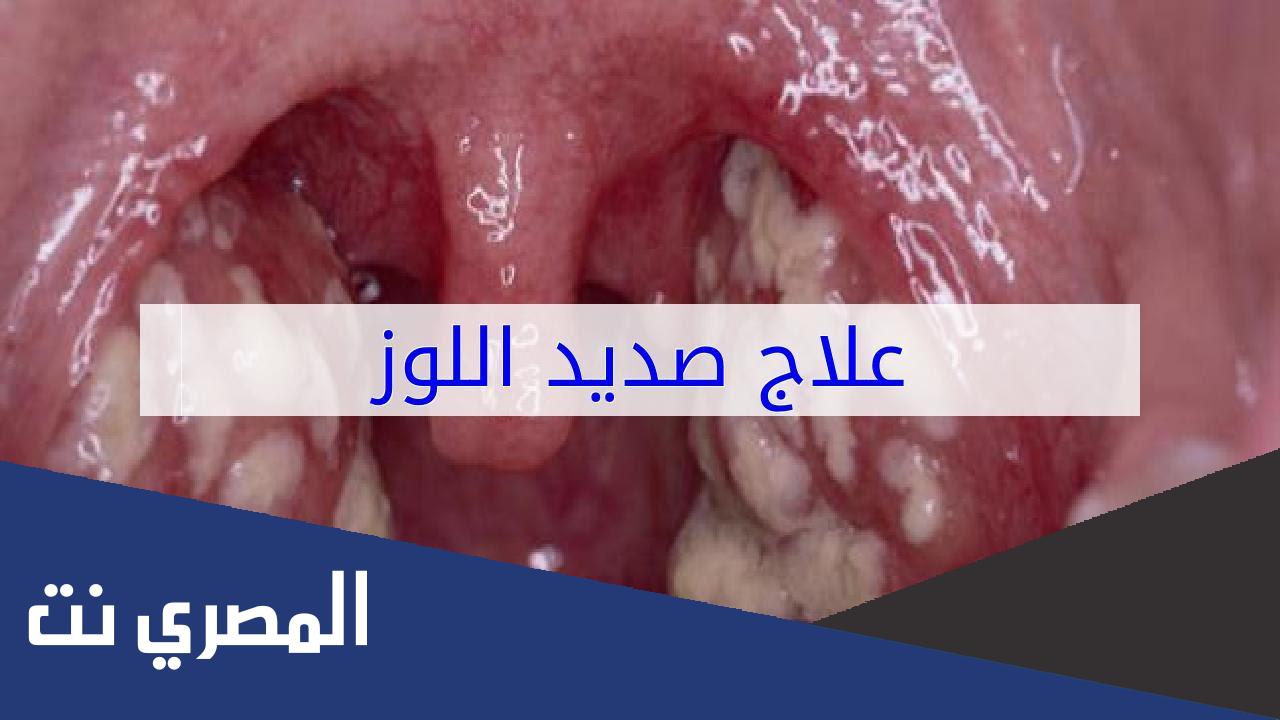 كيفية علاج صديد اللوز