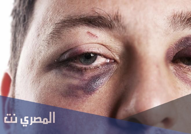 كيفية علاج كدمات الوجه
